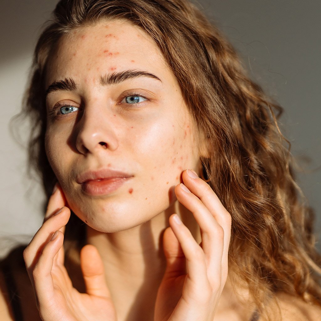 Bagaimana Stres Mempengaruhi Munculnya Jerawat