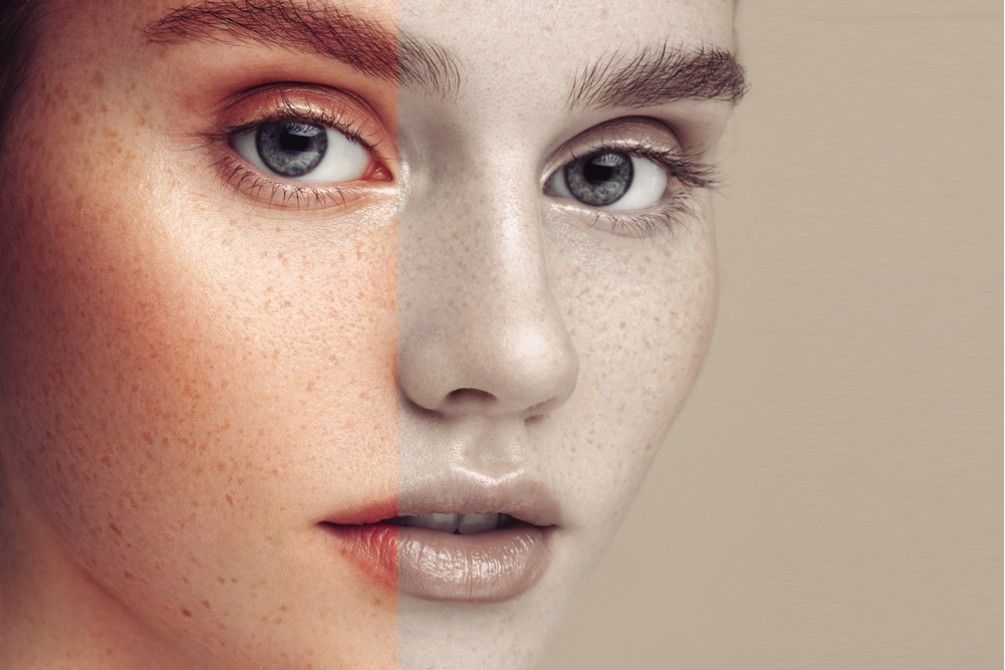 Pengaruh Stres Terhadap Proses Penuaan Kulit